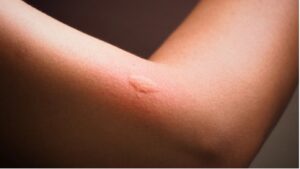 How to Get Rid of Mosquito Bites?