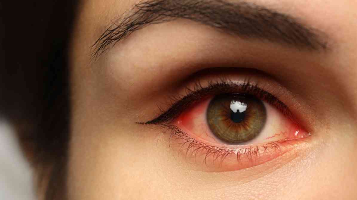 Red Inflamed Eye