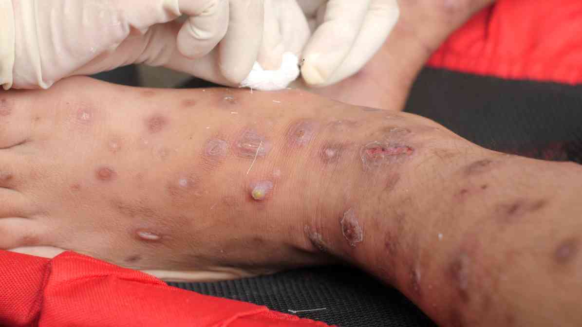 Defence Against Bed Bug in Singapore - Infected Wound - Innovative Pest Pte Ltd Defence Against Bed Bug in Singapore - Infected Wound