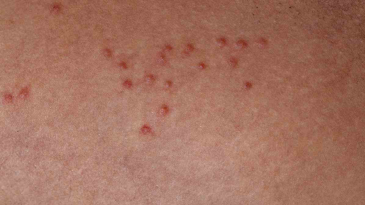 Defence Against Bed Bug in Singapore - itch - Innovative Pest Pte Ltd Defence Against Bed Bug in Singapore - itch