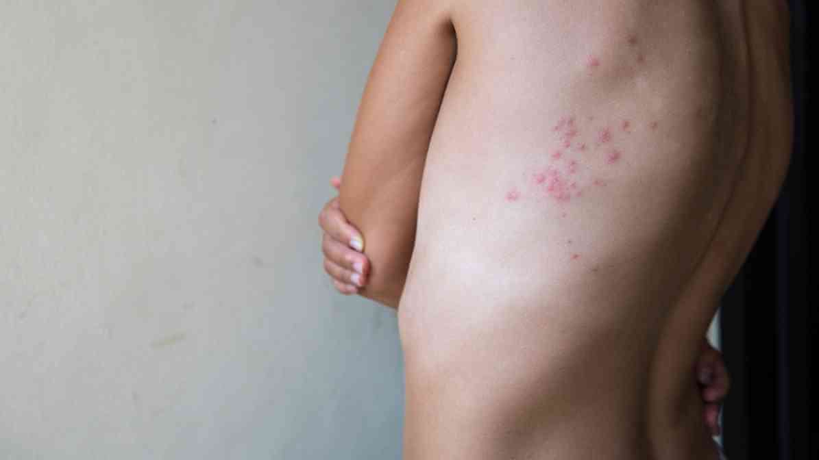 Guide to Prevent and Kill Bed Bugs by Expert - Bed Bug Bites