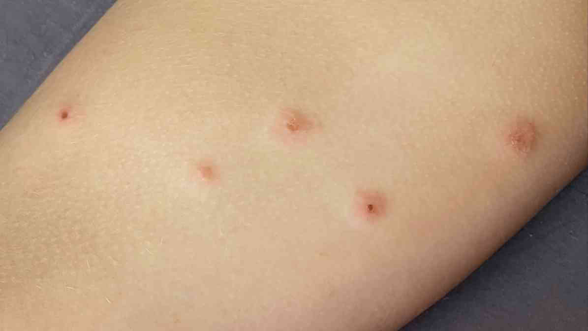 Learn More About Bed Bugs What Causes Bed Bugs - Bed Bug Bites - Innovative Pest Pte Ltd Learn More About Bed Bugs What Causes Bed Bugs - Bed Bug Bites