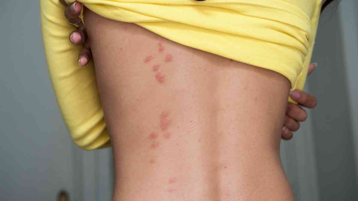 What Causes Bedbugs - Feeding Patterns