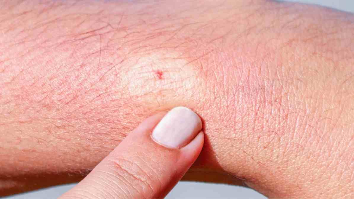 Everything You Need to Know About Bee Sting - Inflamed Skin