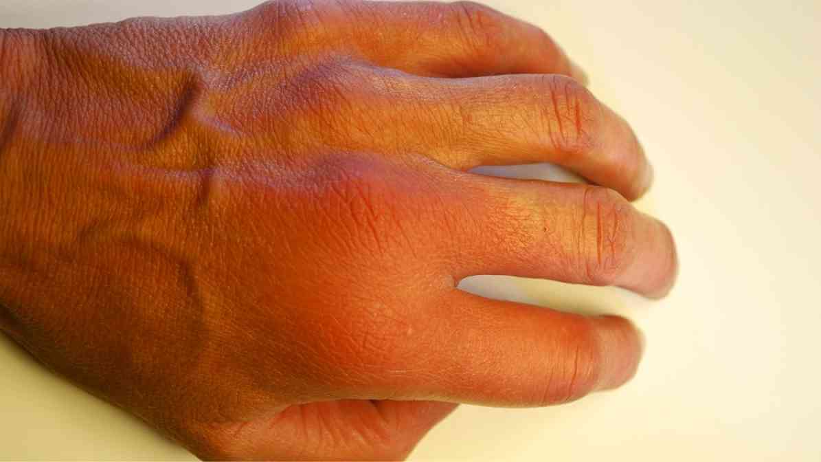 Everything You Need to Know About Bee Sting - Neutralise Venom