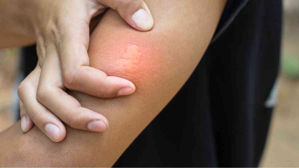 Everything You Need to Know About Bee Sting - Reduce Pain
