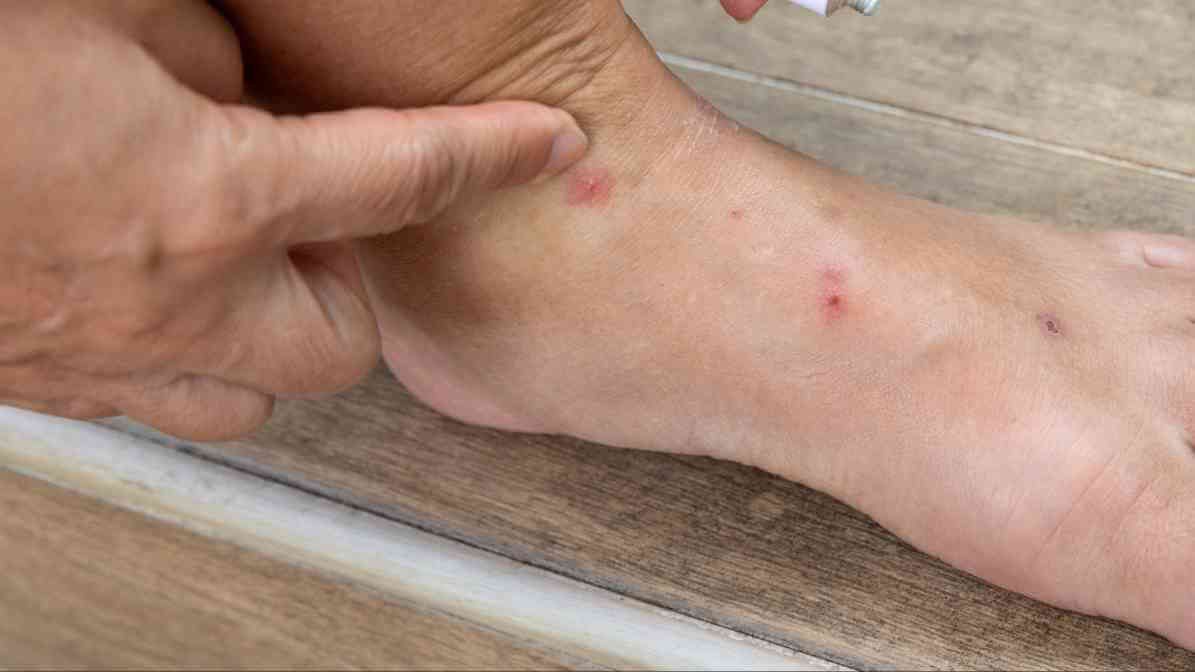 Flea Bites vs Bed Bugs - What Every Pet Owner Must Know - Innovative Pest Pte Ltd Flea Bites vs Bed Bugs - What Every Pet Owner Must Know
